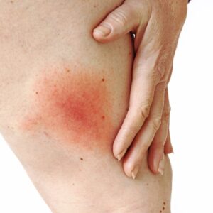 a caucasian person rubbing their leg that has a red rash from a tick bite.