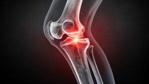 artistic rendering of the knee joint with red representing knee pain